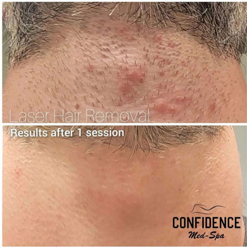 before and after photos of laser hair removal on a male hairline