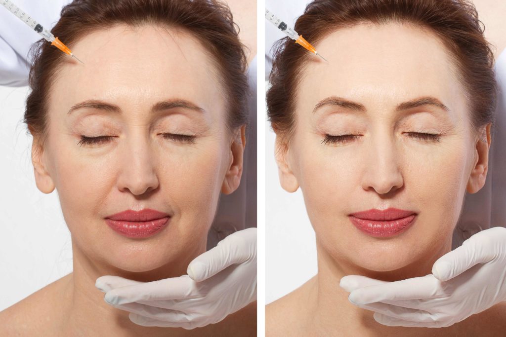 Before and after photo of a woman who got Dysport injections