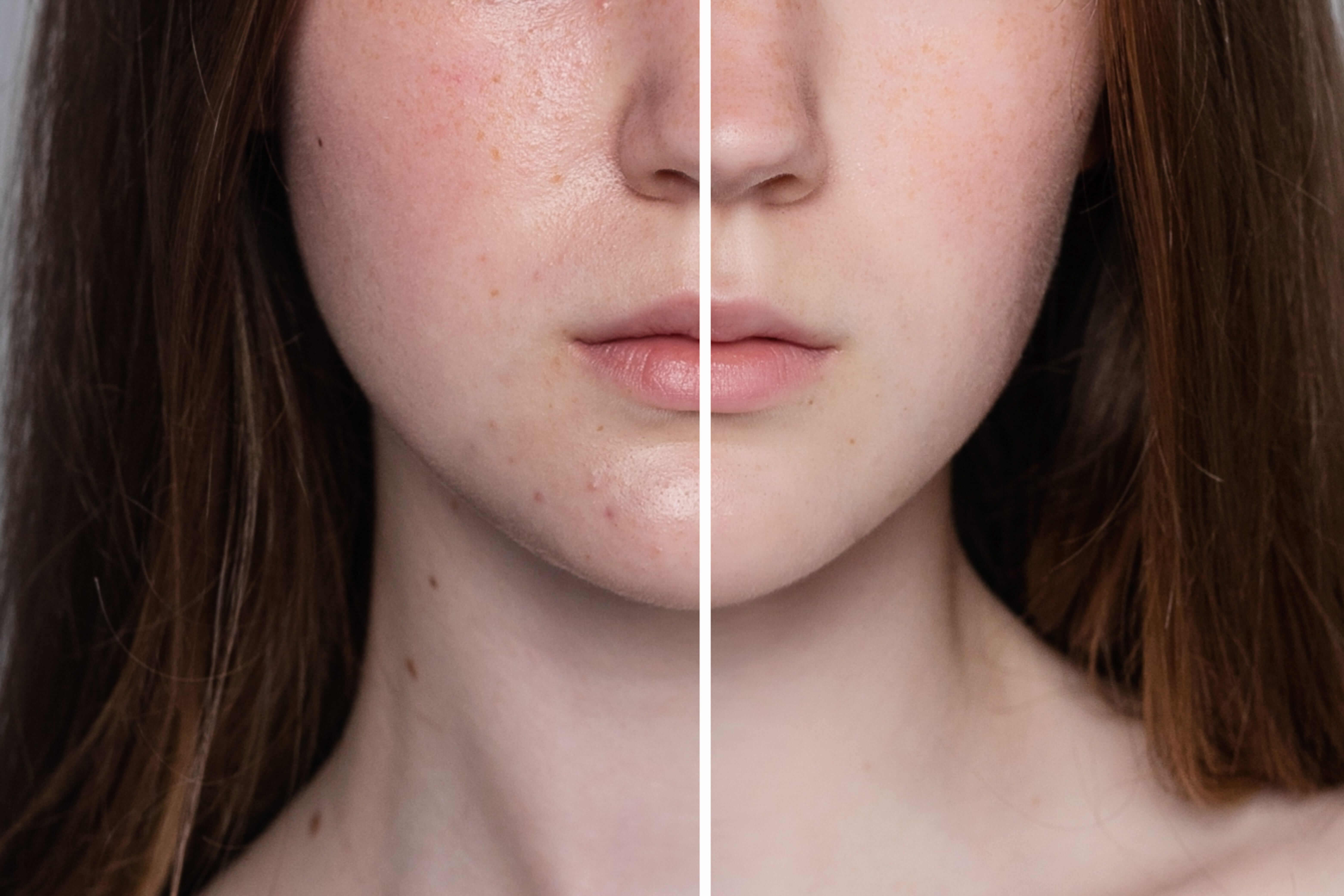 Before and after LaseMD treatment for acne scars.