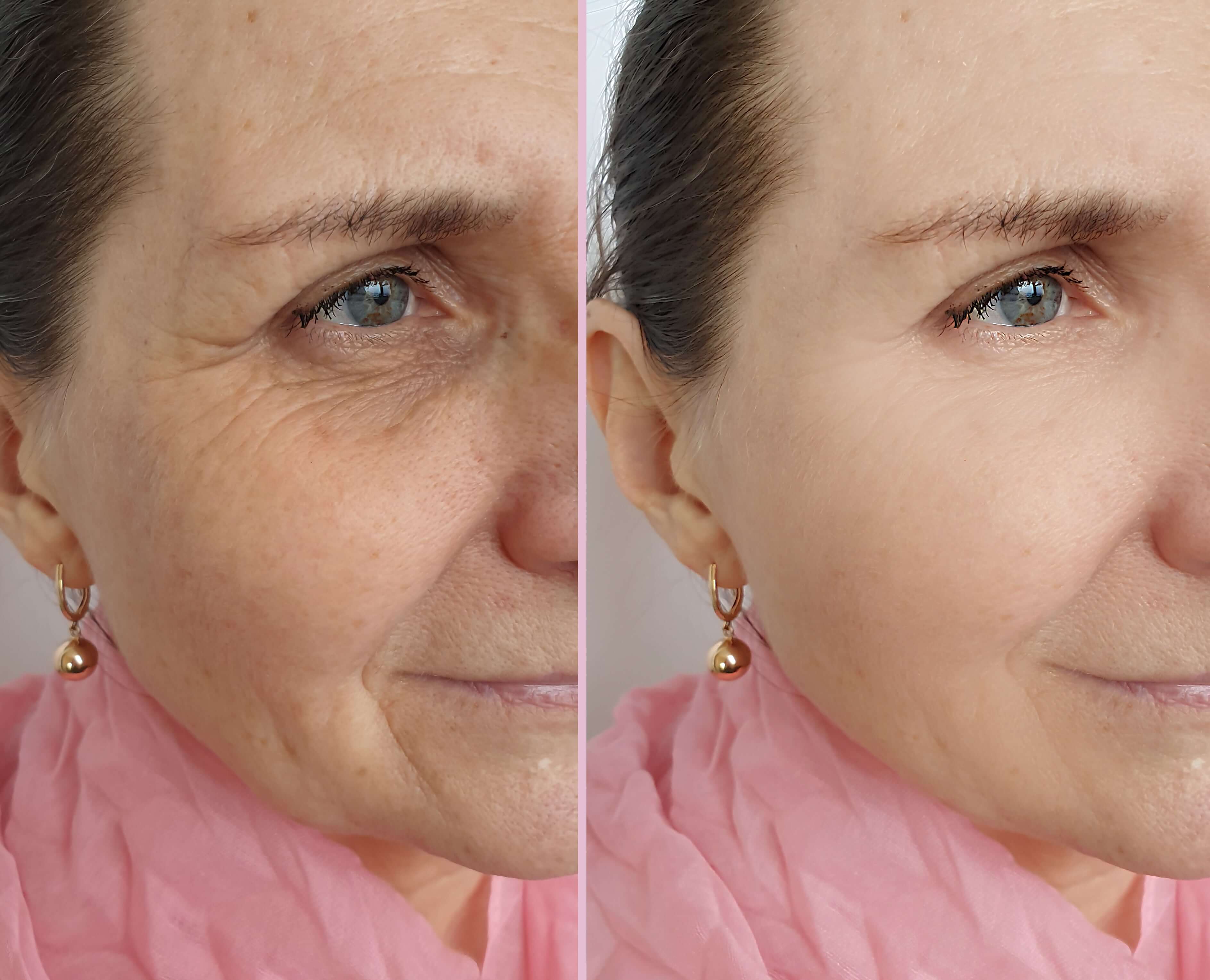 Laser skin resurfacing before and after to treat wrinkles.