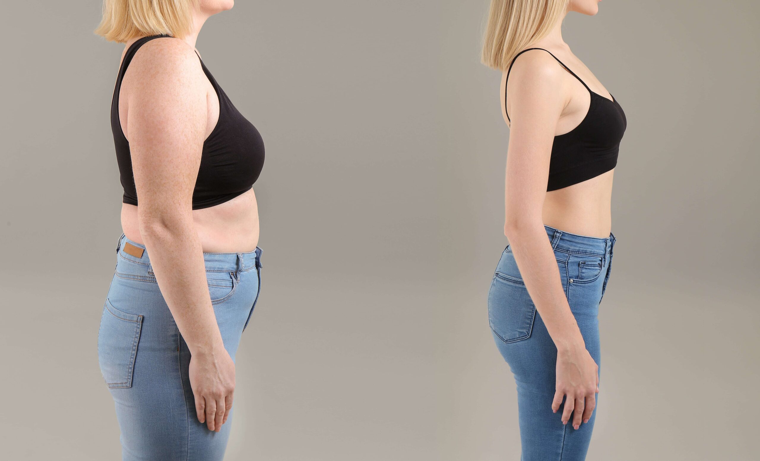 Before and after results of a tummy tuck.